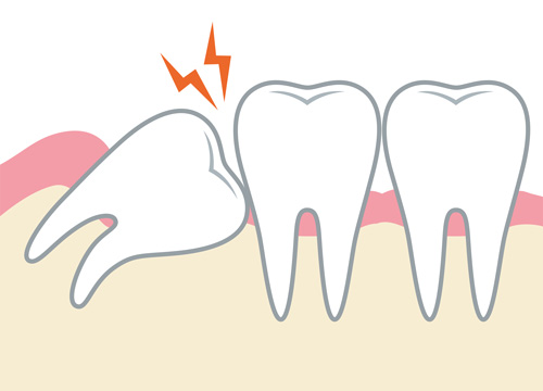 親知らずが隣の歯に悪影響を及ぼしているイラスト