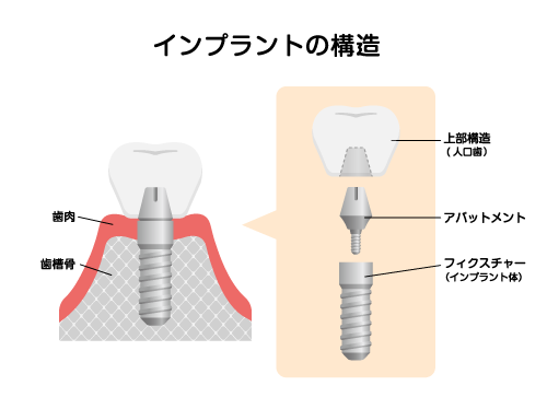 インプラントの構造